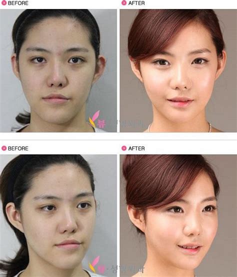 lv plastic surgery seoul